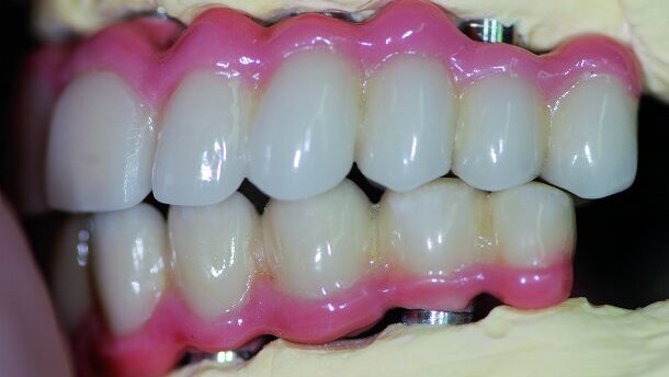 La réalité modifiée en prothèse conjointe