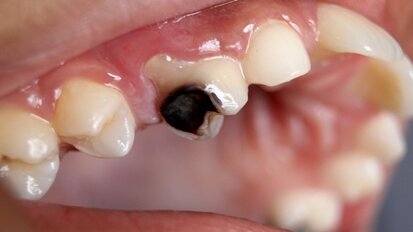 Editorial: Can we rebuild the lost enamel?