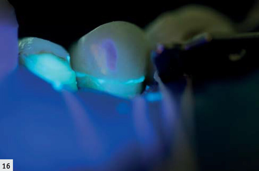 Fig. 16 : Pose d’un onlay en disilicate de lithium ; l’excès de résine composite (G-ænial Anterior, teinte A2) qui doit être éliminé est aisément visible.