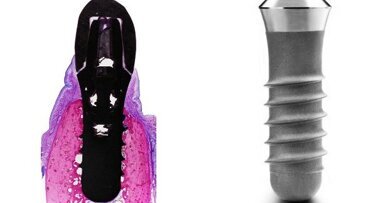 Zahnmediziner belegen Zuverlässigkeit von Implantaten