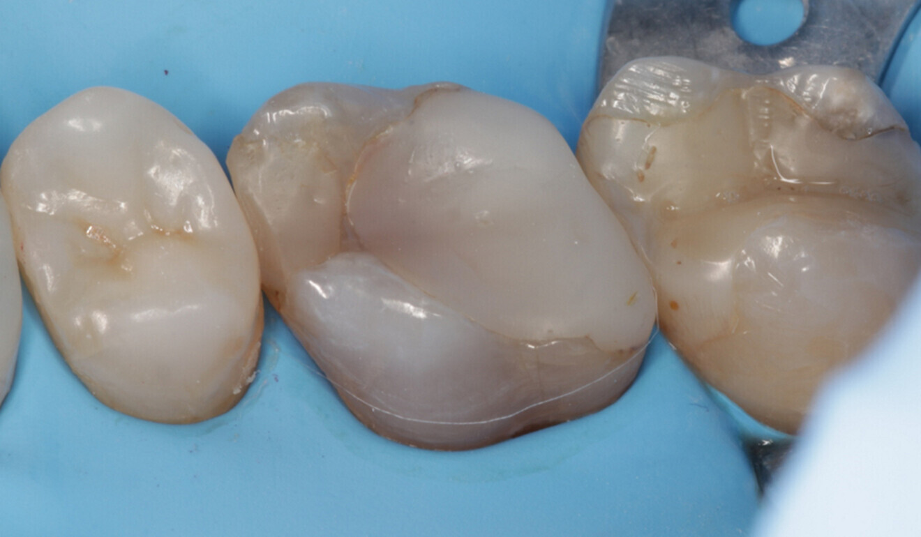 Fig. 2: Initial situation. Unacceptable contact points and palatal wall crack line. (Image: Kuraray Noritake Dental)