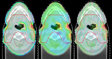 Punktgenaue Strahlentherapie für Krebspatienten