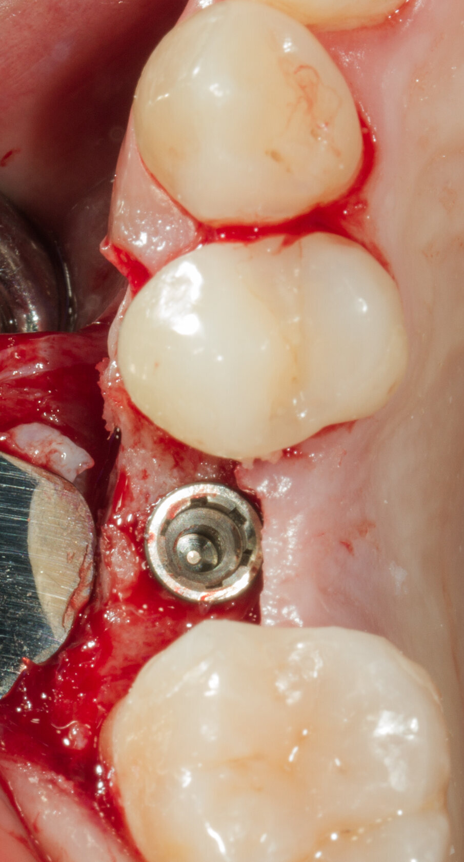 Fig. 22 - Impianto Neoss inserito al centro della cresta ossea.