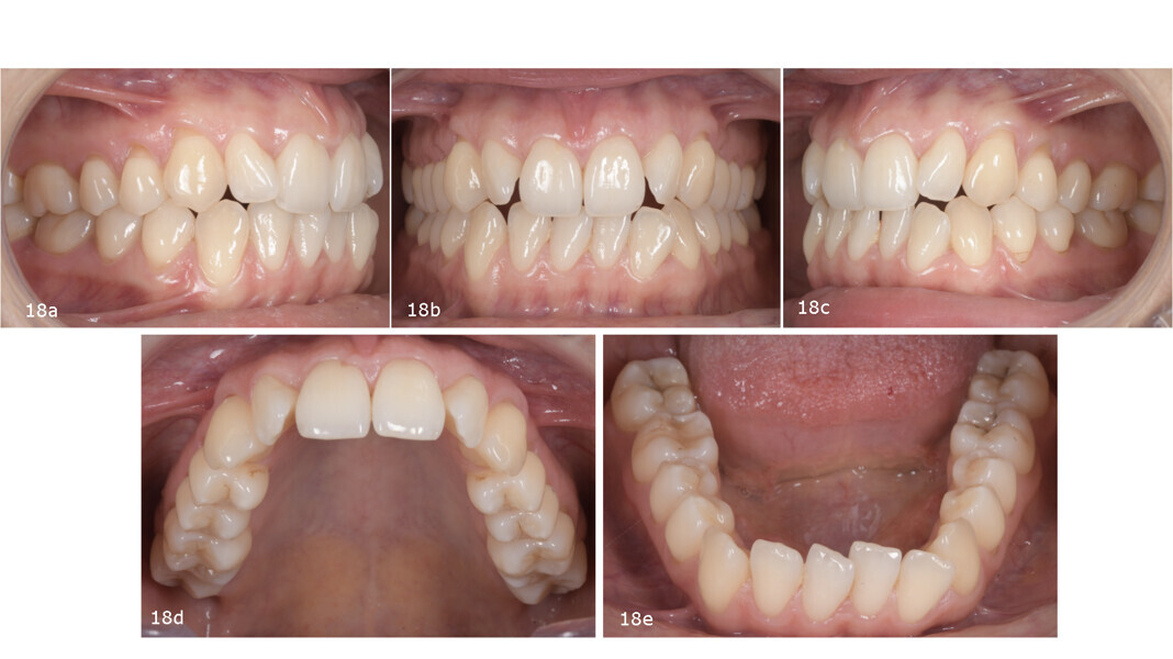 Figs. 18a–e: Pretreatment intra-oral photographs.