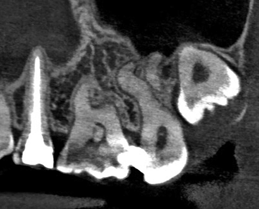 Figs. 4b: The imported scan can be reviewed in the axial (a), sagittal (b), and coronal (c) planes and the software presents a 3-D reconstruction view (d) where the transparency of the teeth can be changed.