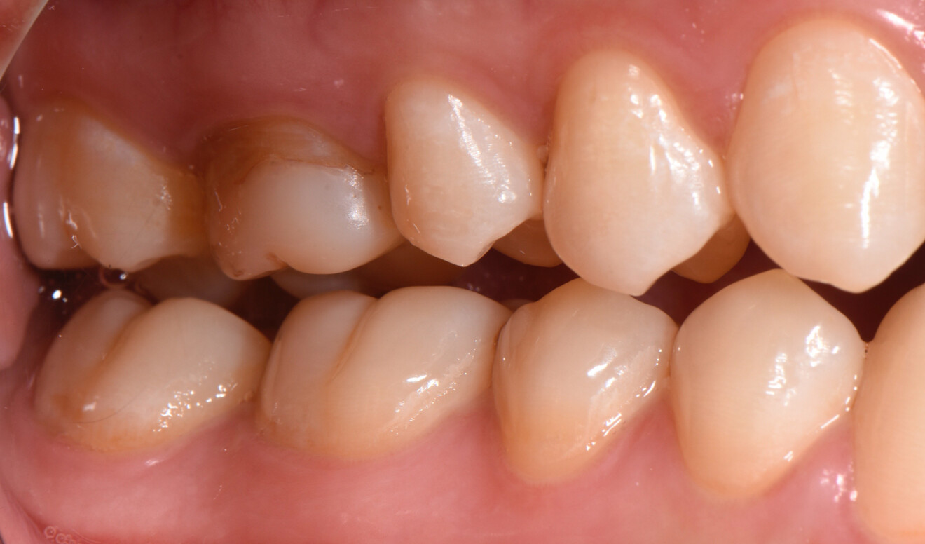 Fig. 1b: Initial clinical situation. Large composite restoration showing a stained, leaking buccal margin.