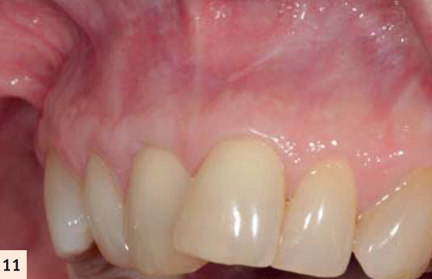 figure 11 : Vues pré- et postop (2 ans). Noter l’augmentation tridimensionnelle de la zone de tissu kératinisé et attaché, ayant pour résultat la restauration de la perte d’attachement et la correction de la
déformation gingivale en hauteur et en largueur.