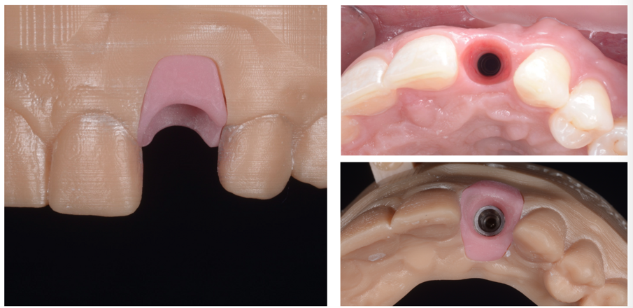 Figg. 12a-c_Corrispondenza di condizionamento tissutale tra bocca e modello stampato.