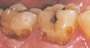 Anesthesia-free and drill-free deep decay removal