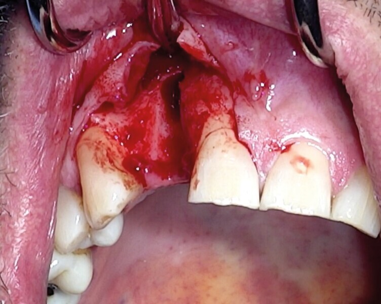 Fig. 13 : Perte osseuse (photo issue de vidéo). 