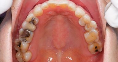 USA: Nella gestione dell’amalgama nuova regolamentazione dell’EPA