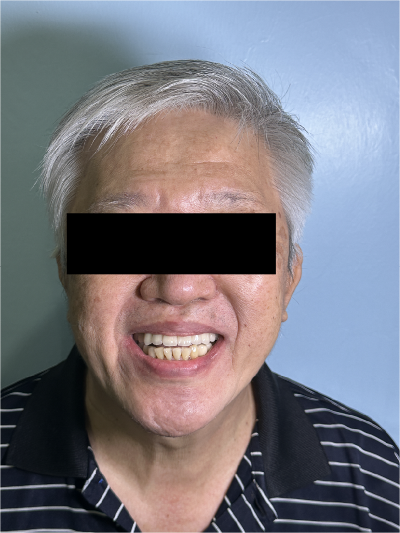 Fig. 3n: Frontal view during maximum smile demonstrating appropriate tooth display and smile harmony  after treatment