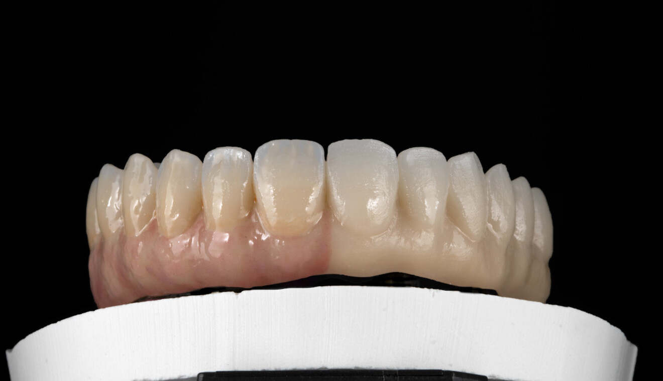 Fig. 9b: Application of GC Initial IQ Lustre Pastes ONE, GC Initial Spectrum Stains and GC Initial IQ Lustre Pastes NF Gum Shades during internal characterisation at more advanced stage.