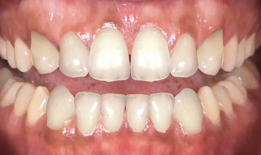 Fig. 13: Intra-oral and extra-oral final digital result.
