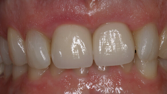 Esthetic management of adjacent maxillary central incisors: Extraction, immediate placement and immediate provisionalization