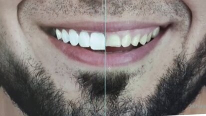 Rehabilitacija pacijenata sa sniženom VDO - prikaz slučaja