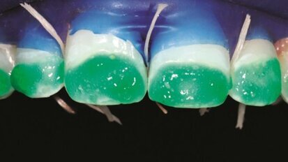 Infiltratie van fluorosevlekken ter bevordering van weefselconservering