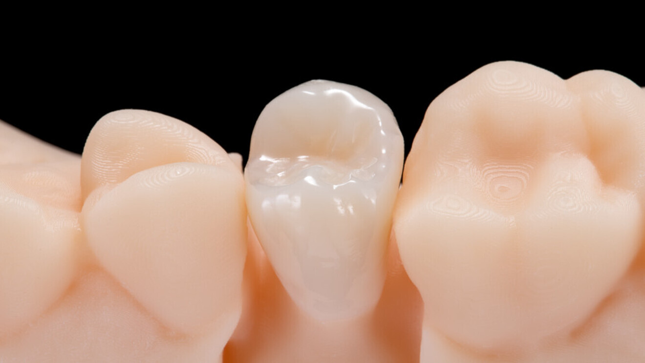 Figs. 3 & 4: The crown looked very natural and required no reworking.