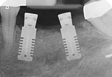 Fig. 13 - RX postintervento.