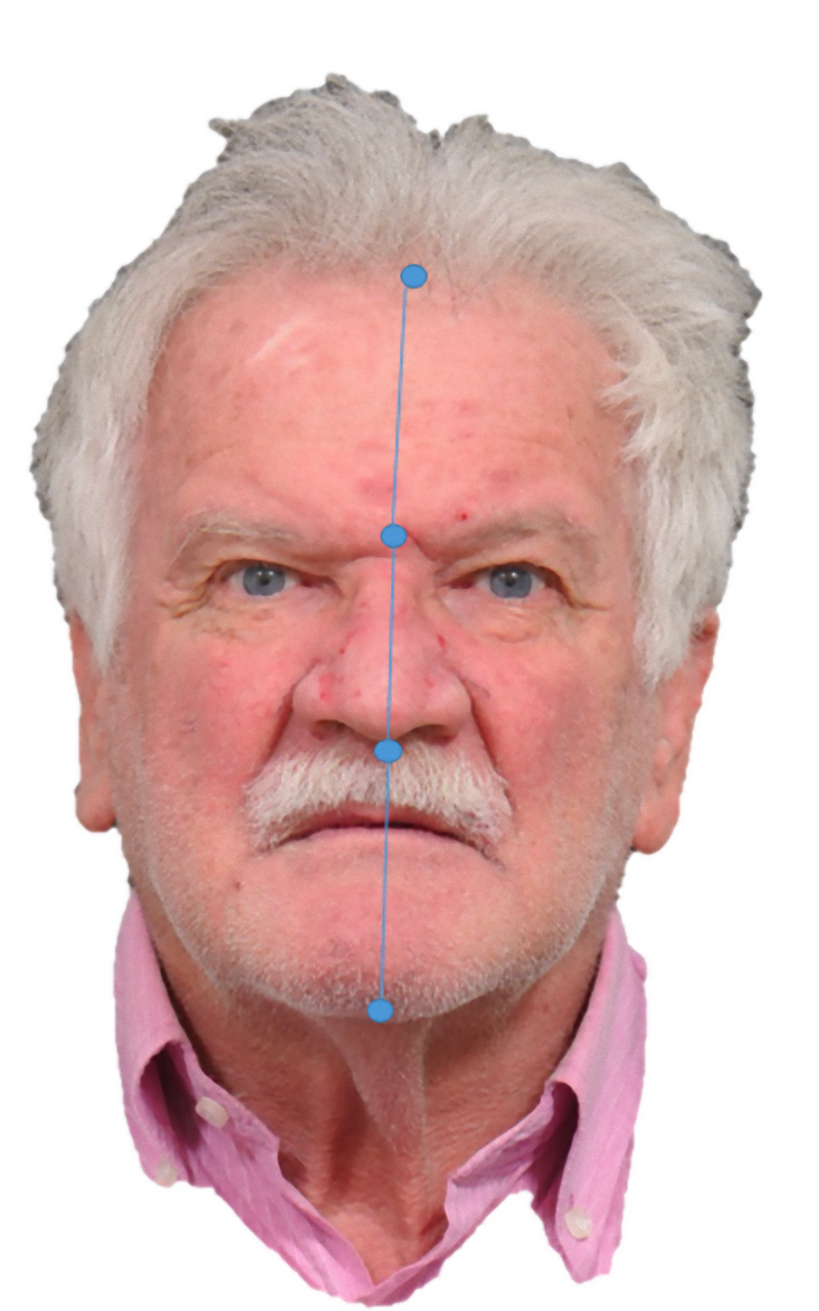 Fig. 2_Analisi frontale. Proporzioni ideali secondo Farkas 1/3-1/3-1/3.