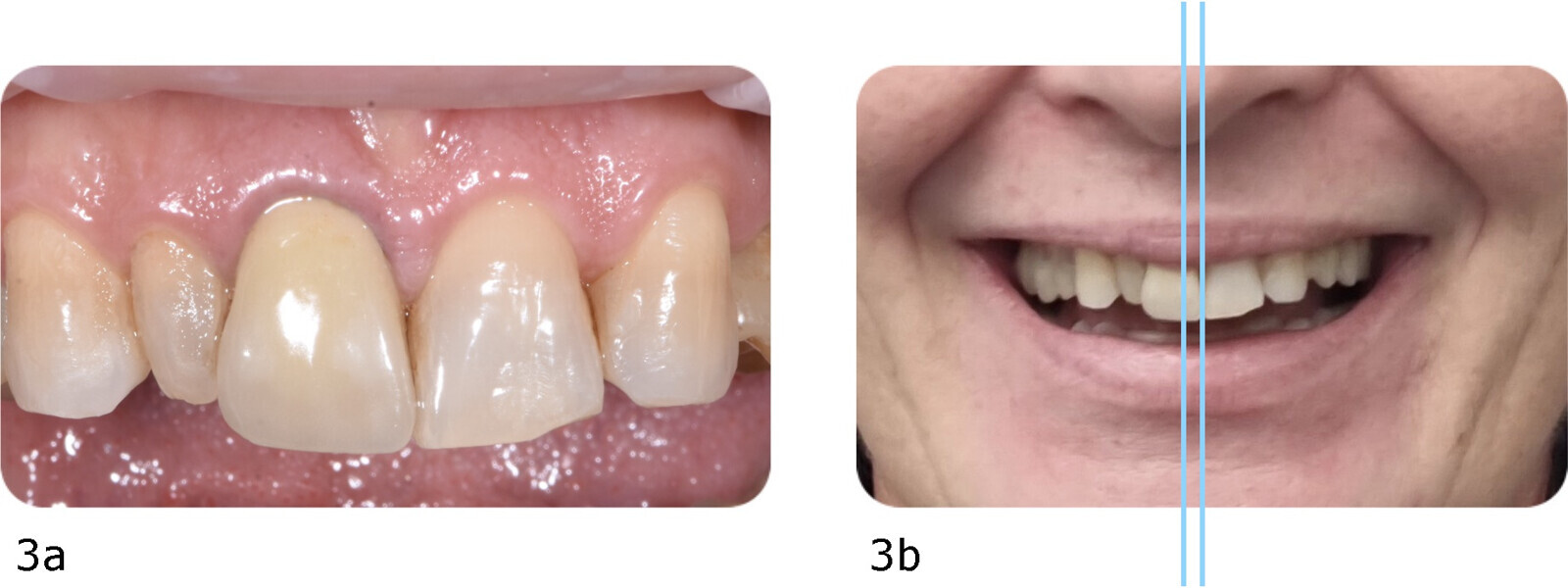 Figs. 3a & b: Favourable factors: (a) large central incisors and (b) midline deviation of < 4 mm.