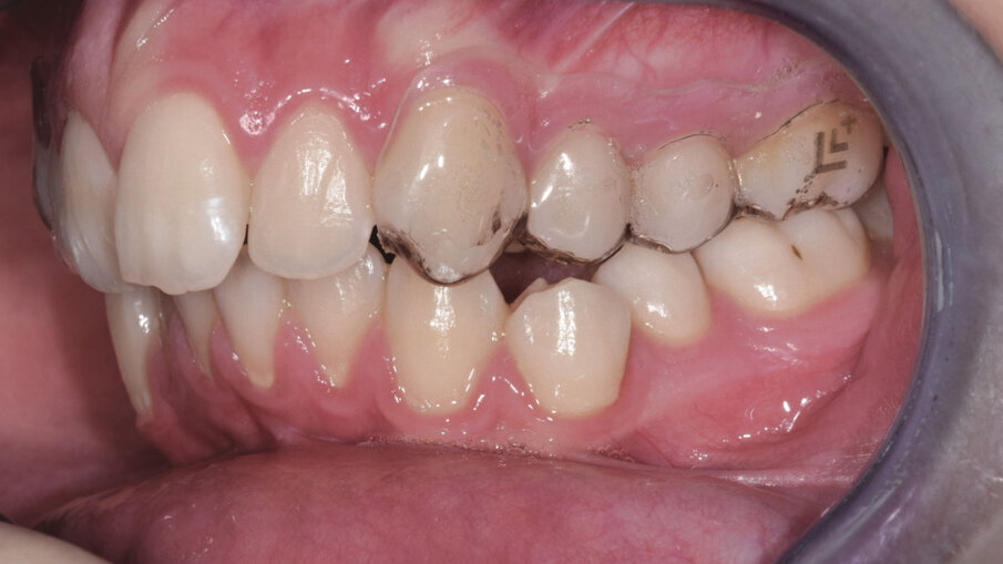 Figg. 2a-2c_Utilizzo del dispositivo ALLEO+ come ausiliare per espandere e ottenere spazio in arcata superiore, al fine di utilizzare, successivamente, un numero di allineatori ridotto e una minore quantità di stripping.