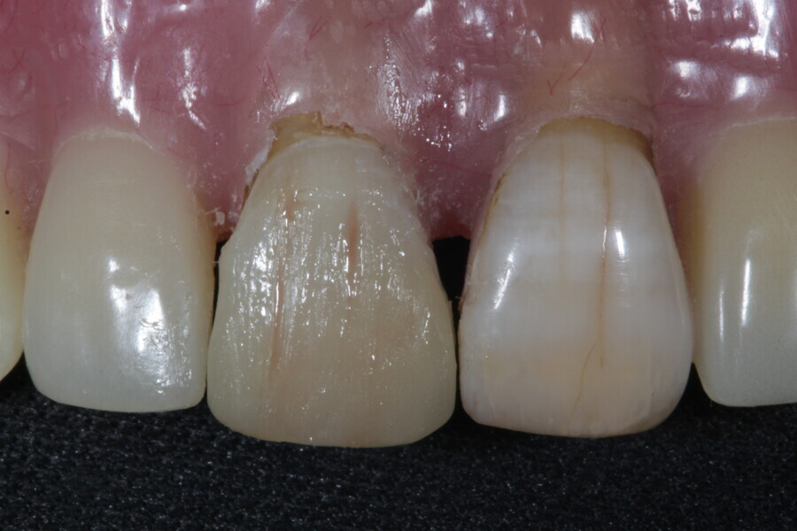 Fig. 17: Dark brown staining is applied to mimic tooth #21.