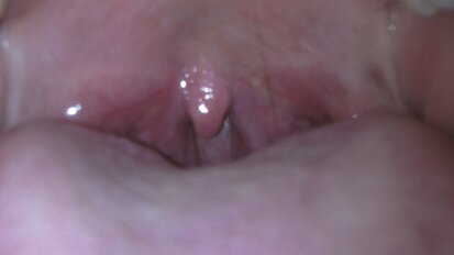 Laserowe leczenie chrapania i bezdechu sennego