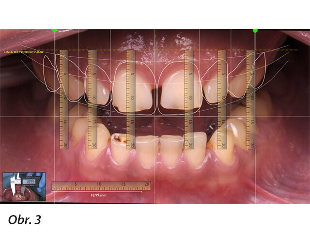Obr. 3: Digitální linie úsměvu DSD a zkalibrované digitální pravítko k preciznímu měření, ke kvantitativnímu hodnocení estetických nedostatků a také ke zhotovení trojrozměrného modelu v klasické analogové (voskový wax-up na sádrovém modelu) nebo digitální (tisk 3D wax-upu) technice