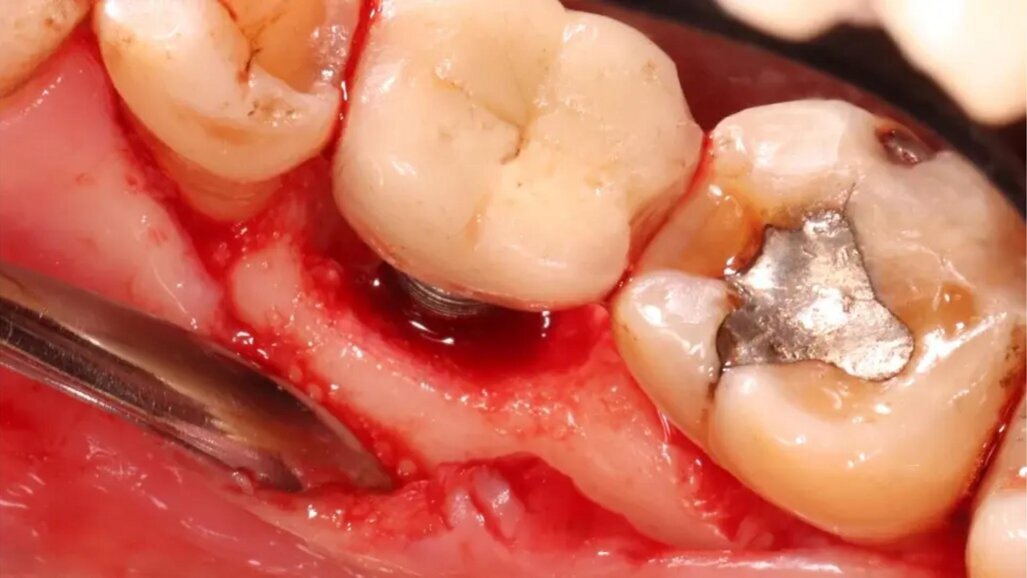 Ali lahko citronska kislina reši zobne vsadke, prizadete zaradi periimplantitisa?