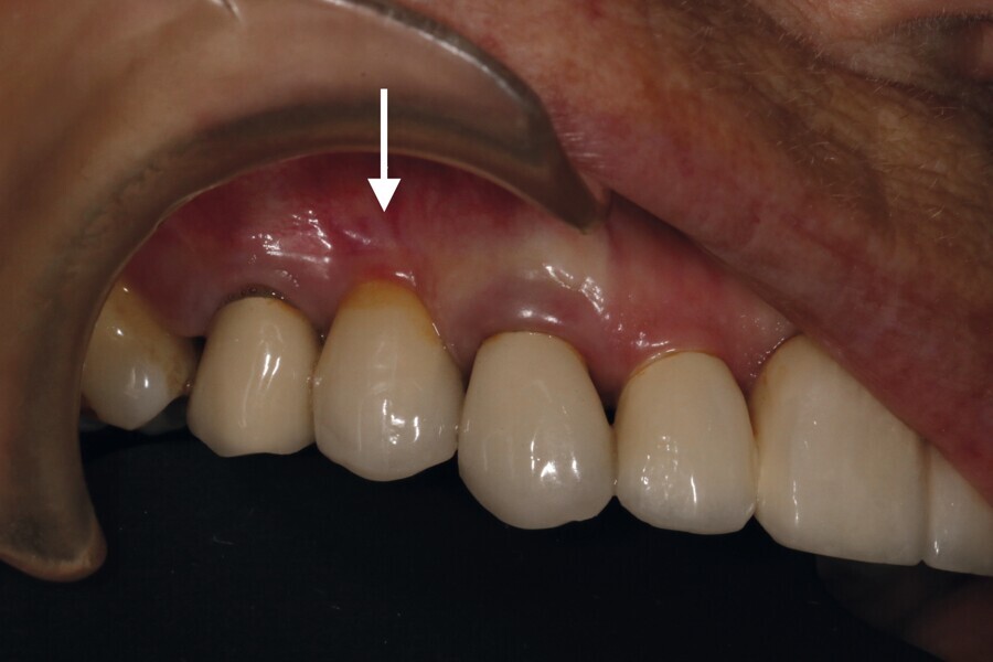 Fig. 12 : Contrôle à dix ans de la 14