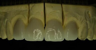 Lithium disilicate—An effective solution for aesthetically demanding indications