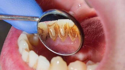 New research provides faster cheaper method to treat periodontitis New research provides faster cheaper method to treat periodontitis