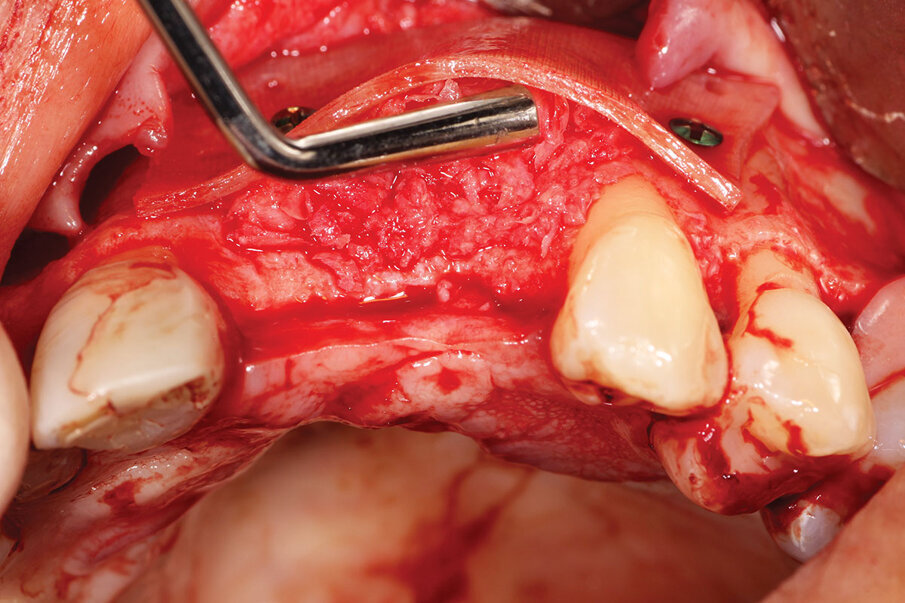 Fig. 6: ‘Gummy bone’ being placed between the facial aspect of the ridge, and the bone plate placed to widen the ridge to allow implant placement after healing. 