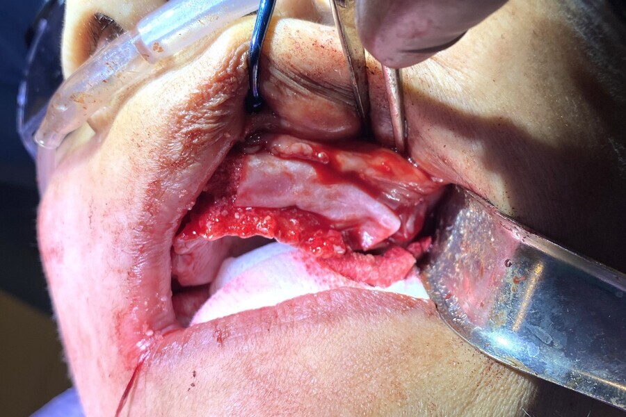 Fig. 19b: Collagen membrane placed over the graft site.