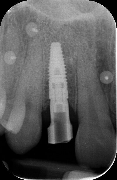 Fig. 14 - Rx endorale dello scan body in posizione.