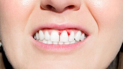 Parodontitis kostte Europa 158,6 miljard euro in 2018