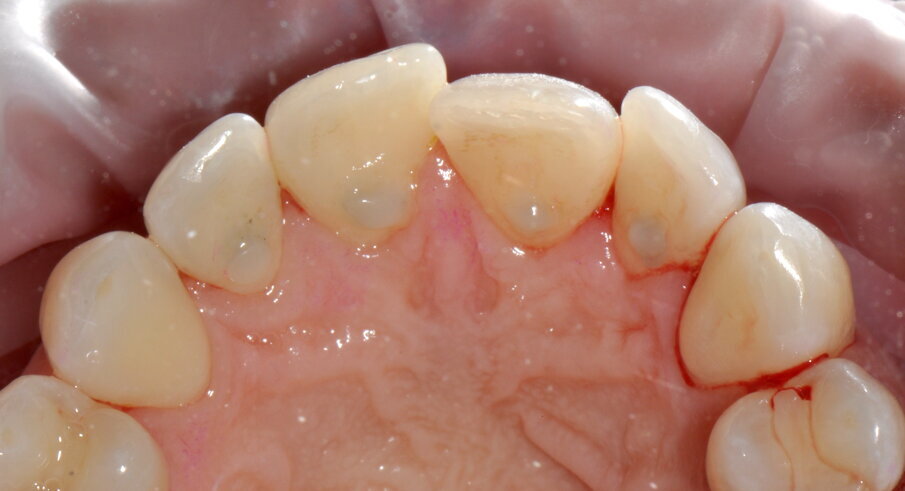 Figg. 4a-4f - Confronto fra inizio e termine della terapia. Le immagini (4a-c) mostrano le aree vestibolare palatale e linguale prima della terapia, mentre le immagini (4d-f) mostrano le aree vestibolare palatale e linguale dopo della terapia.