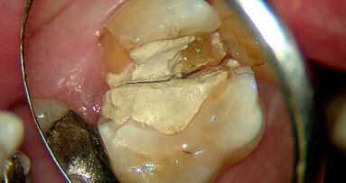 Problemmanagement in der Endodontie