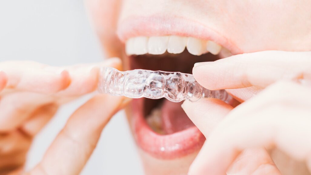 Cursos sobre alineadores dentales