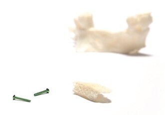 Straumann Allografts