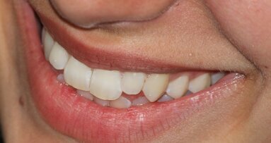 30% młodych Europejczyków ma ubytki szkliwa zębów