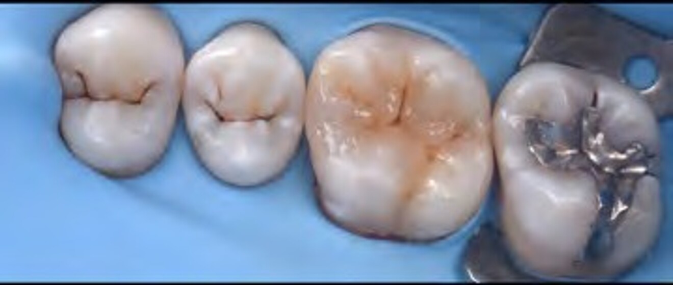 Fig. 2i: Sequential polishing initiated to smooth the restoration and blend the margins with the surrounding enamel. 