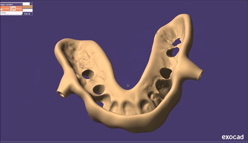 Figg. 26-28_Progettazione Cad con exocad.