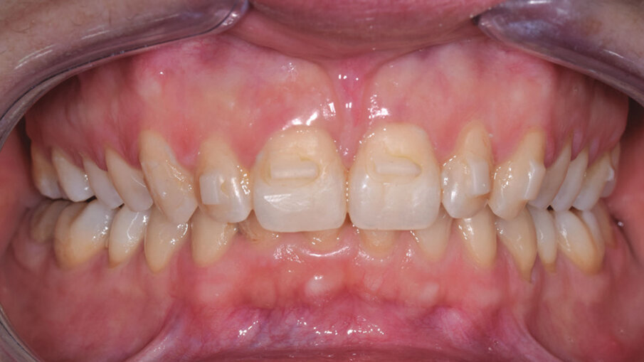 Figg. 7a-7e_Step intermedio. Lo stripping è stato eseguito con le nuove Orthostrips “Central” Intensiv. Una corretta procedura di riduzione interprossimale ci permette di recuperare spazio in arcata per ottenere la risoluzione completa dell’affollamento dentale e delle rotazioni presenti.