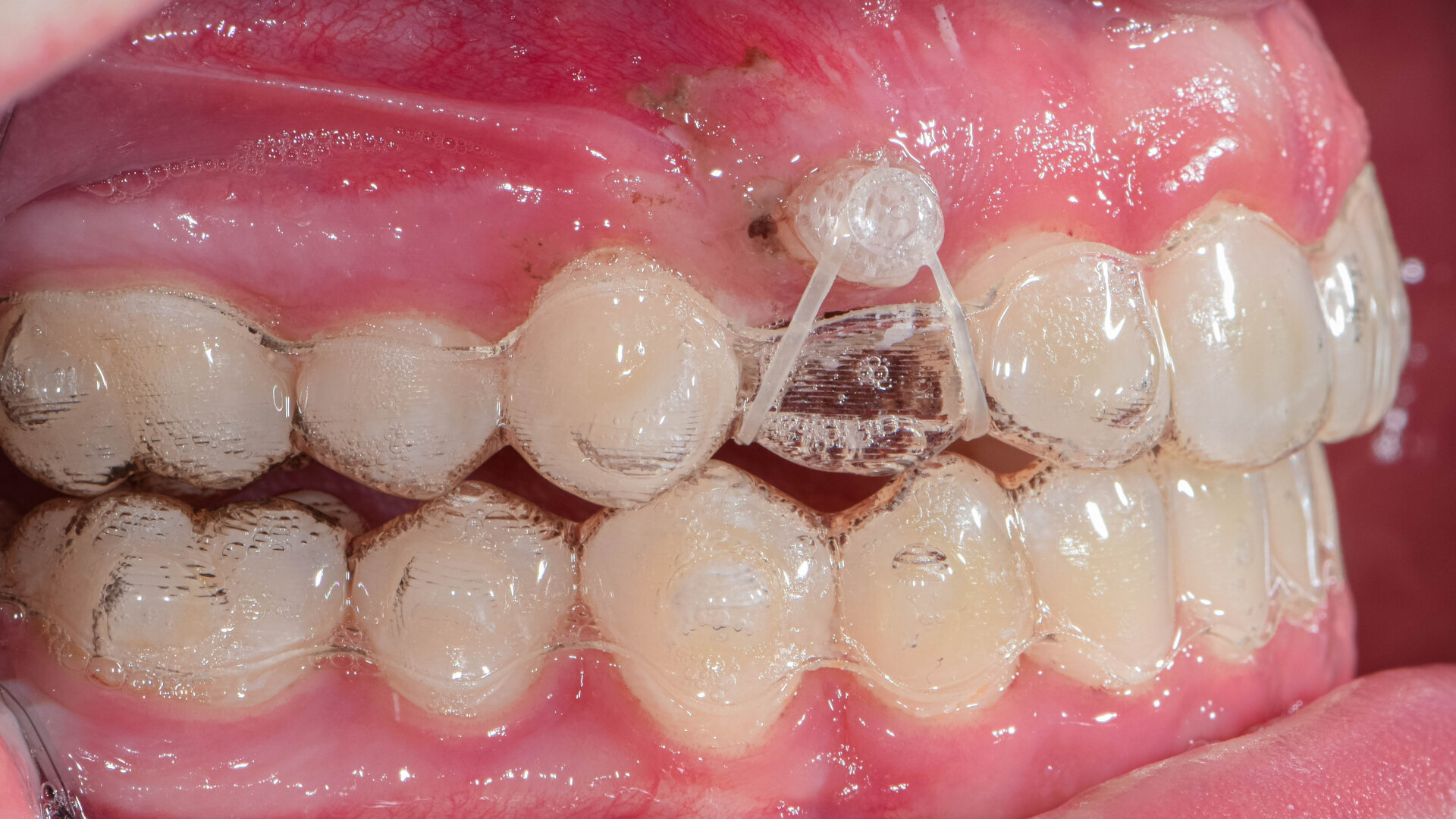 All buttoned up! Styling your plastic with elastics