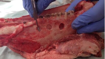 Podśluzówkowa i śródkostna lokalizacja metalowych ciał obcych metodą rezonansu