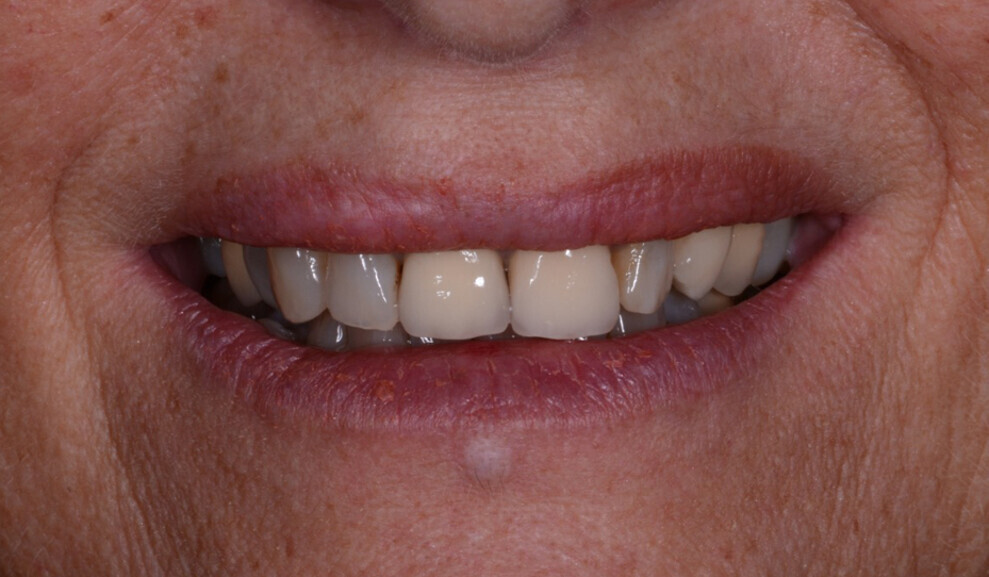 Fig. 1: Facial view of the pre-op clinical situation.