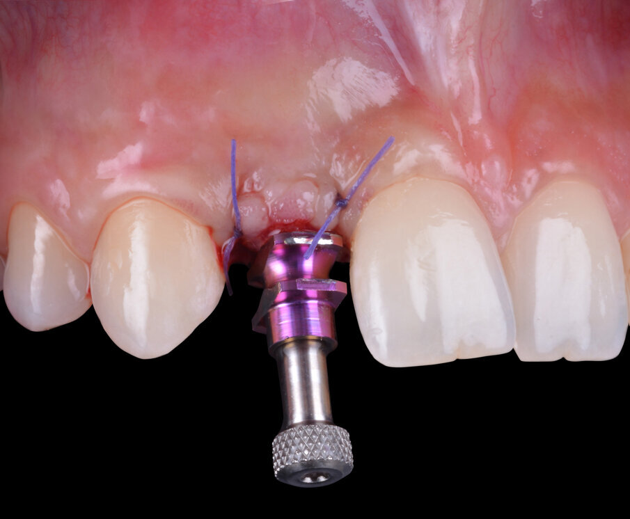 Fig. 11 - Transfert da impronta in posizione.