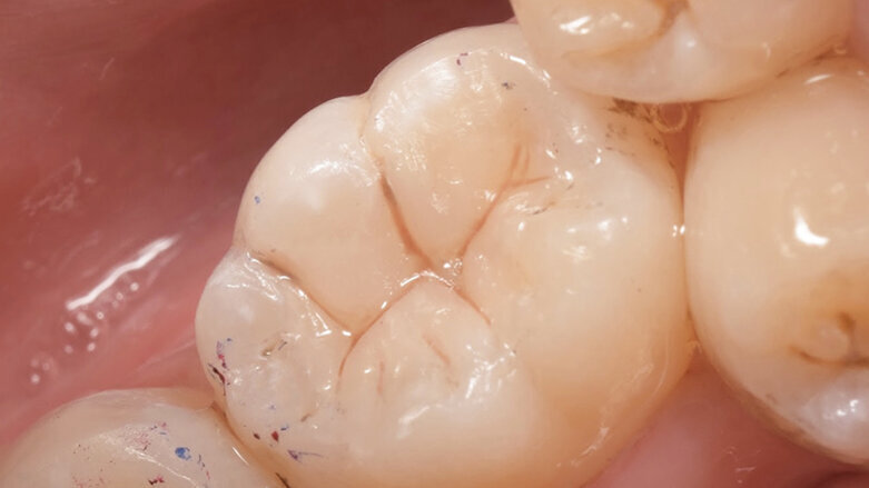 Patient-centric treatment with  composite Artistry